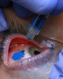 Tatuagem no olho – procedimento e resultados