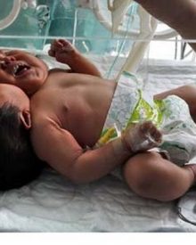 Nasceu um bebé com duas cabeças na China