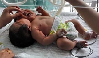 Nasceu um bebé com duas cabeças na China 1