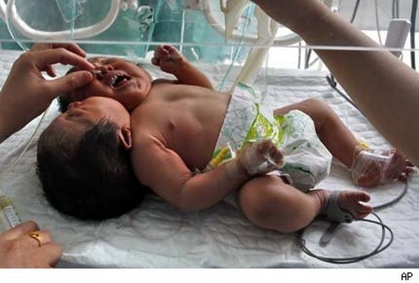 Nasceu um bebé com duas cabeças na China 1